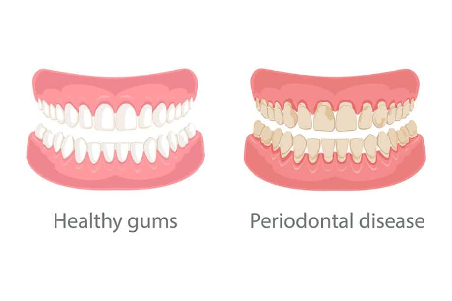 How to Fix Receding Gum