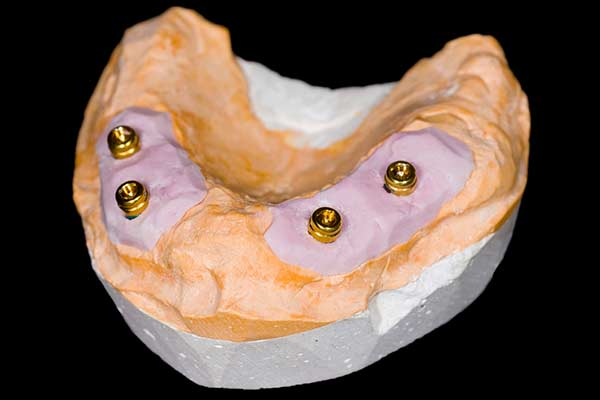 Full Arch with Only Four Implants clay model