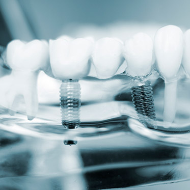 Dental Implants