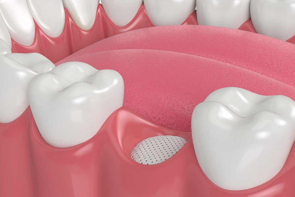 What is Dental Bone Grafting? Peoria, IL