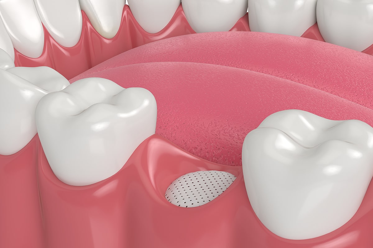 What is Dental Bone Grafting? Peoria, IL